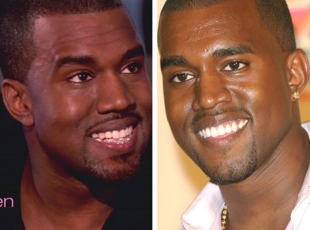 Канье уэст зубы из титана. Кани Уэст виниры. Kanye West Teeth. Kanye West до и после пластики. Kanye West титановые зубы.