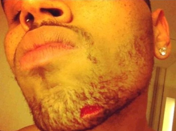 chris brown chin injury nightclub fight